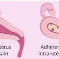 Remède Naturel de la Synéchie de L'Utérus