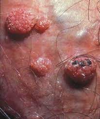 Comment traiter les condylomes Verrues Génitales