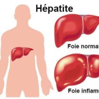 Hépatite A Traitement Naturel