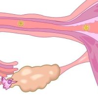 Tisane 204: Débloquer Trompe Bouchée Naturellement , Plantes Soigner Trompes bouchées