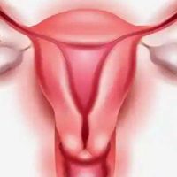 Tisane 225: Ovaires Polykystiques, Traitement Naturel Kystes Ovariens