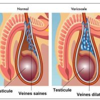 Varicocèle : Définition Symptômes Traitements Varicocèle