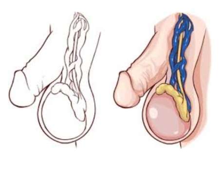 Tout Sur La Varicocèle Traitement Naturel
