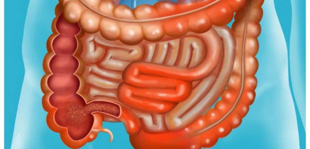 La maladie de crohn symptômes et traitement