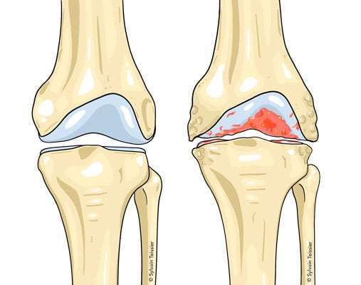 L'arthrose symptômes et traitement naturels