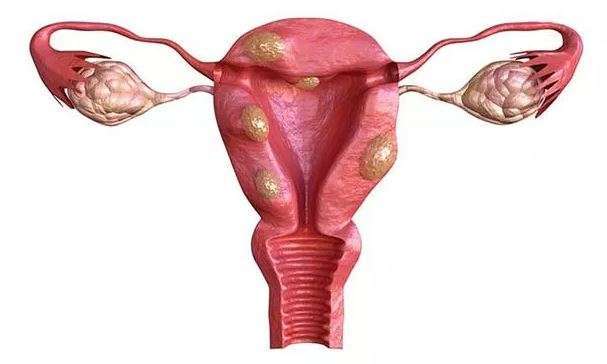 Assécher un fibrome naturellement, Solution Naturelle Fibrome