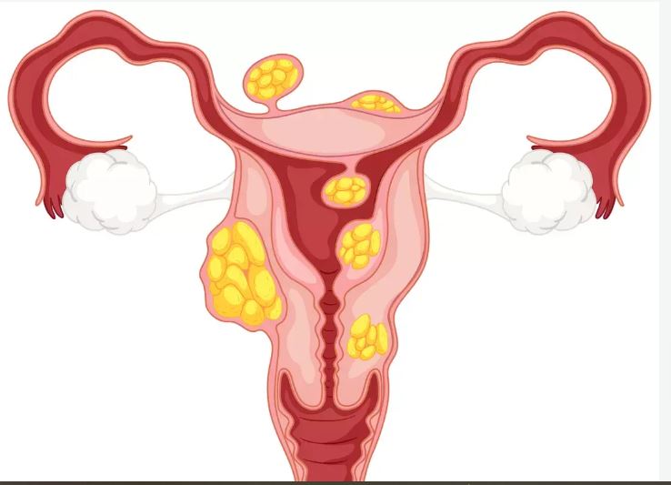 Mon Fibrome a Disparu: Recettes pour Faire Disparaître Fibromes