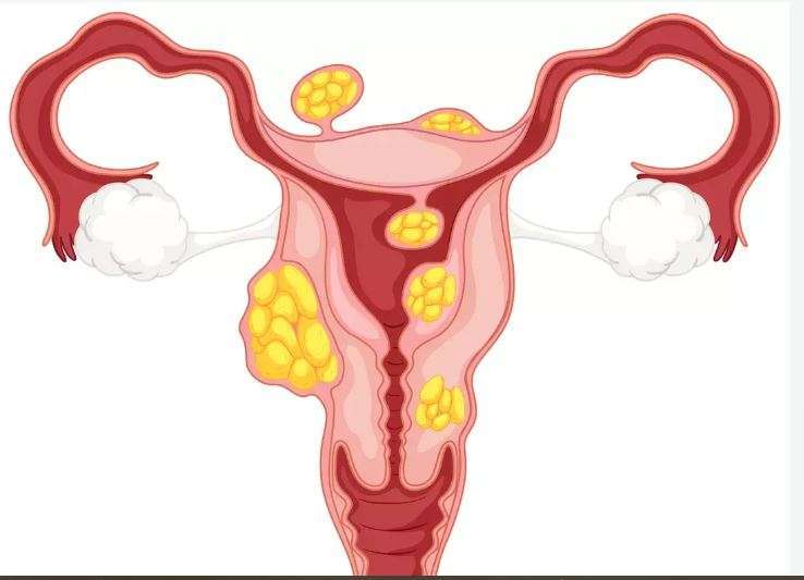 Myomes, Fibromes, kyste ovarien : Remèdes Naturels Tumeur Interne
