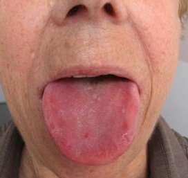 Traitement naturel de l'amygdalite