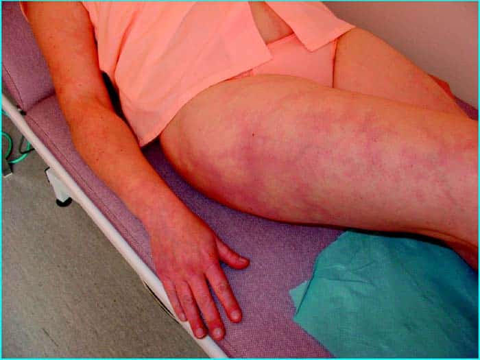 Traitement naturel de l'amygdalite