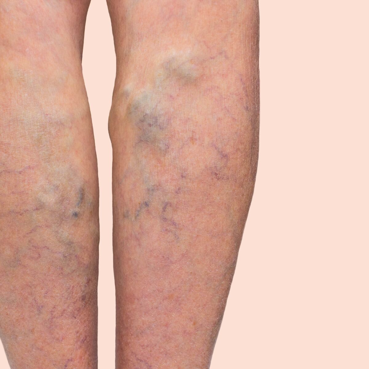 Comment traiter naturellement l'insuffisance veineuse