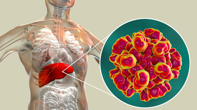 Solution naturelle pour soigner l'hépatite E
