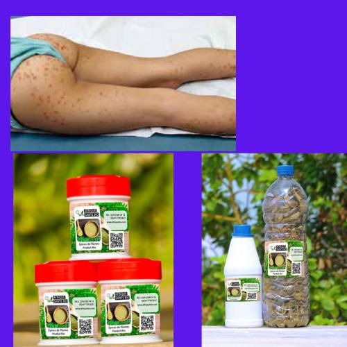 Comment soigner naturellement la vascularite