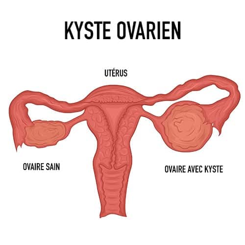 Solution naturelle de kyste ovarien