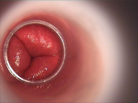 Traitement naturel l'hémorroïde