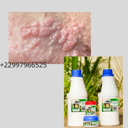 Traitement naturel des condylomes