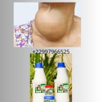 Remède naturel contre le goitre