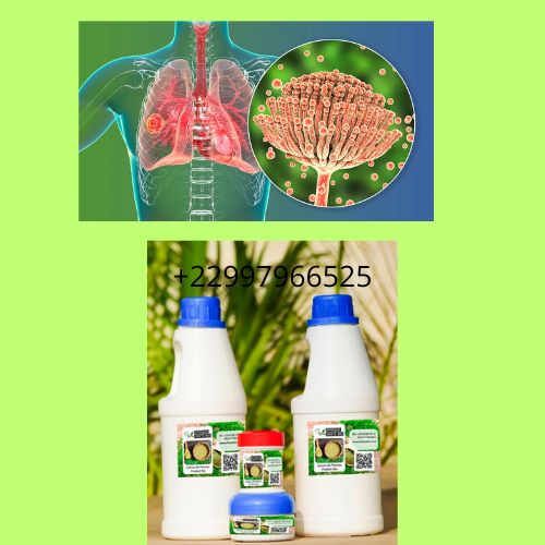 Comment soigner naturellement l'aspergillose ?