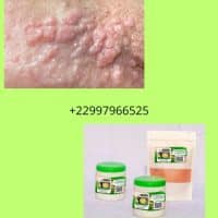 Remède naturel contre les condylomes