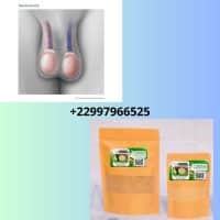 Remède naturel pour guérir la varicocèle