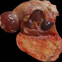 Plante pour soigner les fibromes utérins
