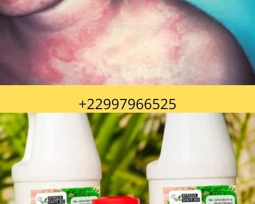 Traitement naturel de Kawasaki