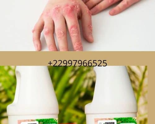 Traitement naturel de syphilis