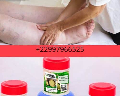 Traitement naturel du lymphœdème