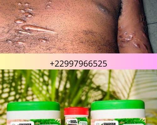 Solution naturelle des chéloïdes