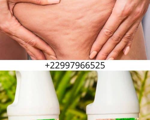 Solution Naturelle Contre La Cellulite