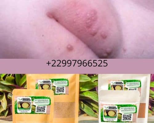 Comment soigner naturellement les condylomes